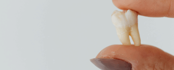High River Teeth Extractions timeline chart showing healing stages at Blossom Dental Centre