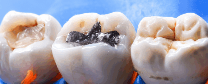 Fillings and tooth sensitivity treatment at Blossom Dental Centre High River nov 25