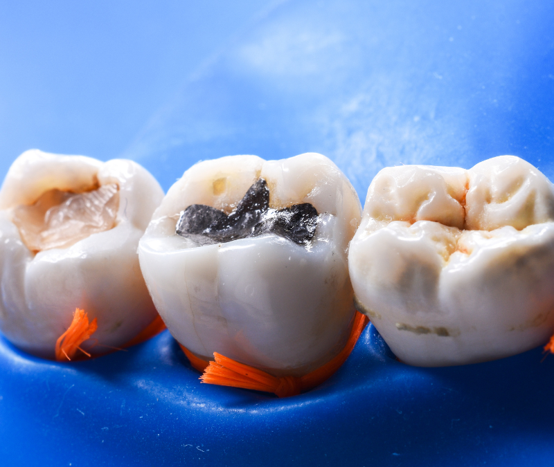 Fillings and tooth sensitivity treatment at Blossom Dental Centre High River nov 25