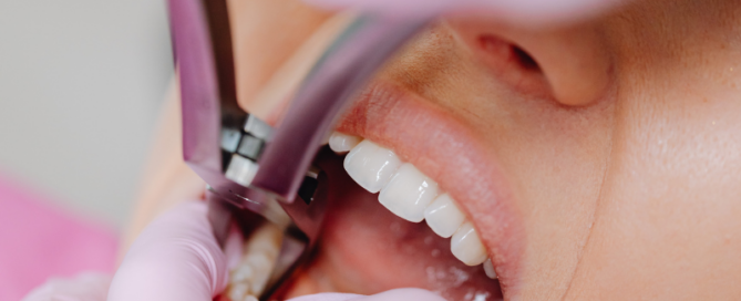 High River teeth extractions consultation at Blossom Dental Centre