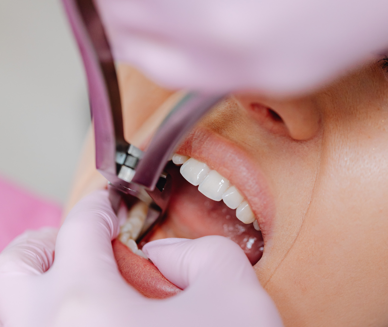High River teeth extractions consultation at Blossom Dental Centre