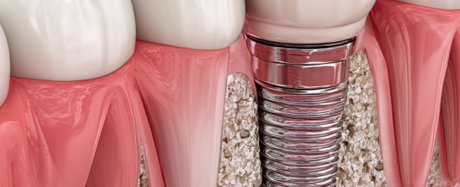 dental implants bone loss consultation at Blossom Dental Centre High River AB