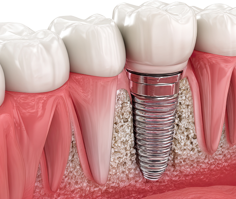 dental implants bone loss consultation at Blossom Dental Centre High River AB